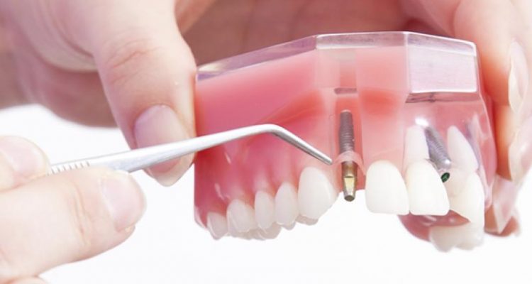 Clinica dentaria santa Catarina et implants dentaire brésiliens implants dentaire brésiliens