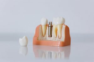 Implants-dentaires-a-l-etrangers