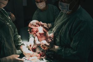 trois chirurgien en train de sortir un bébé lors d'une opération césarienne