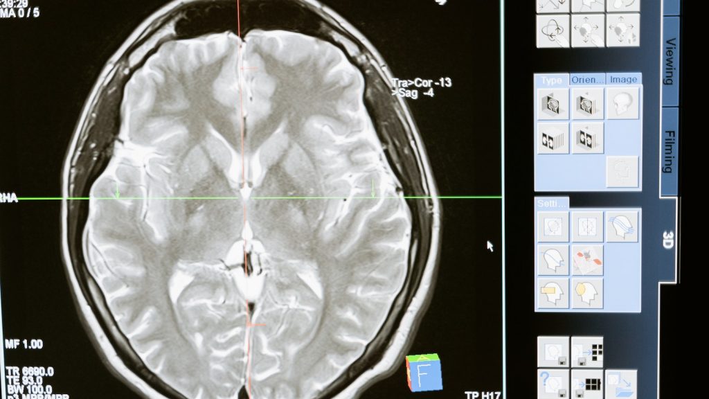 scanne du cerveau